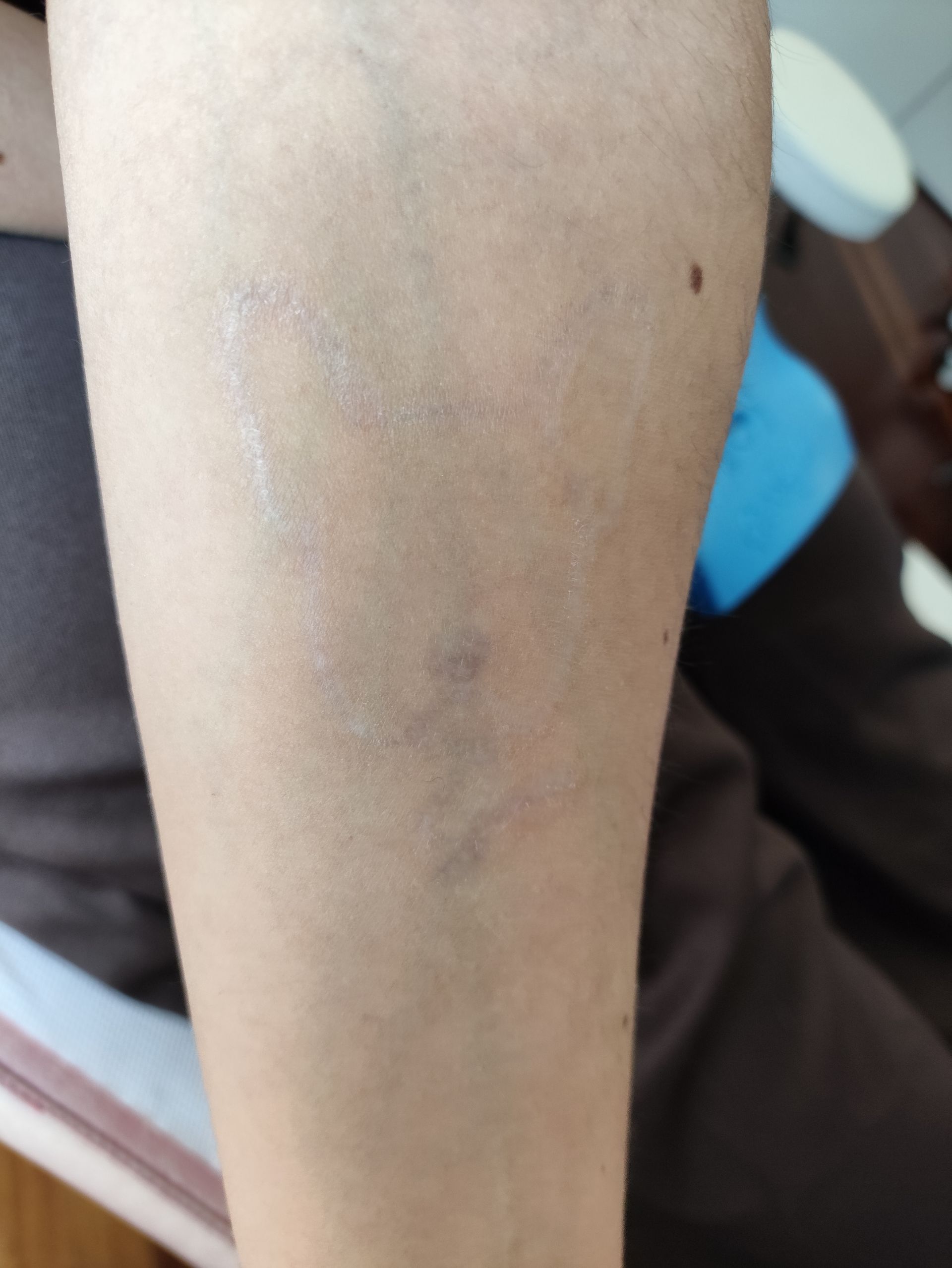 Rimozione tatuaggio dal braccio di una ragazza