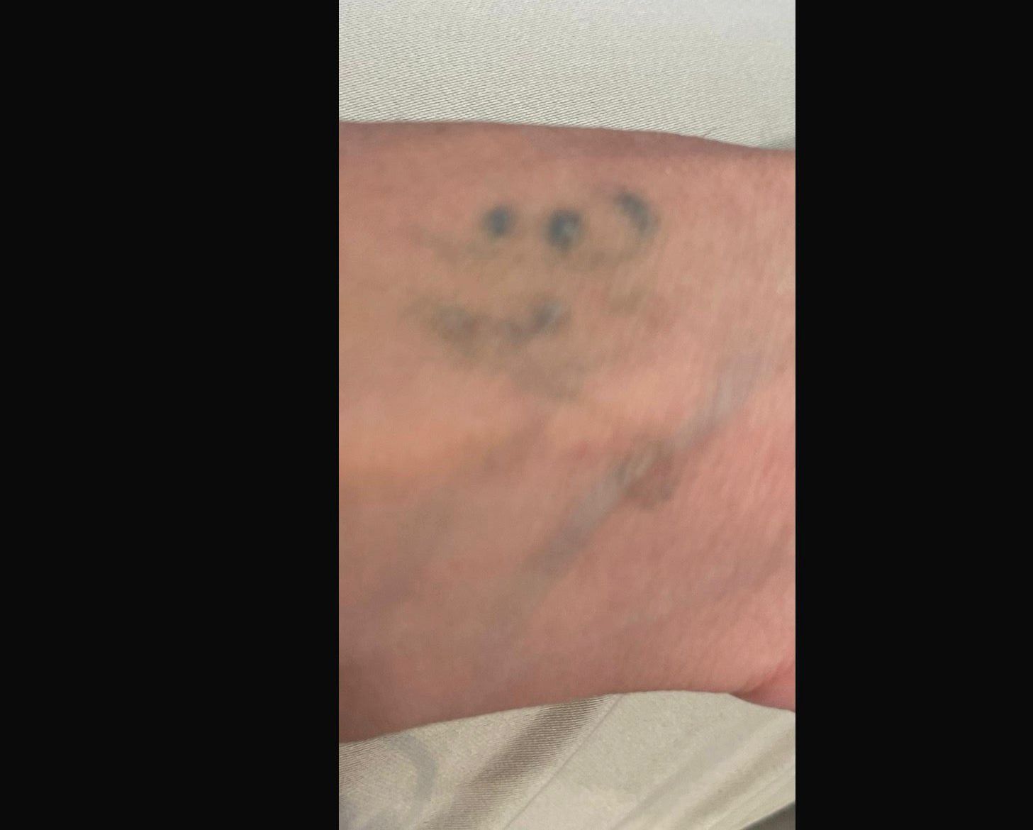 Tatuaggio durante il trattamento di rimozione.