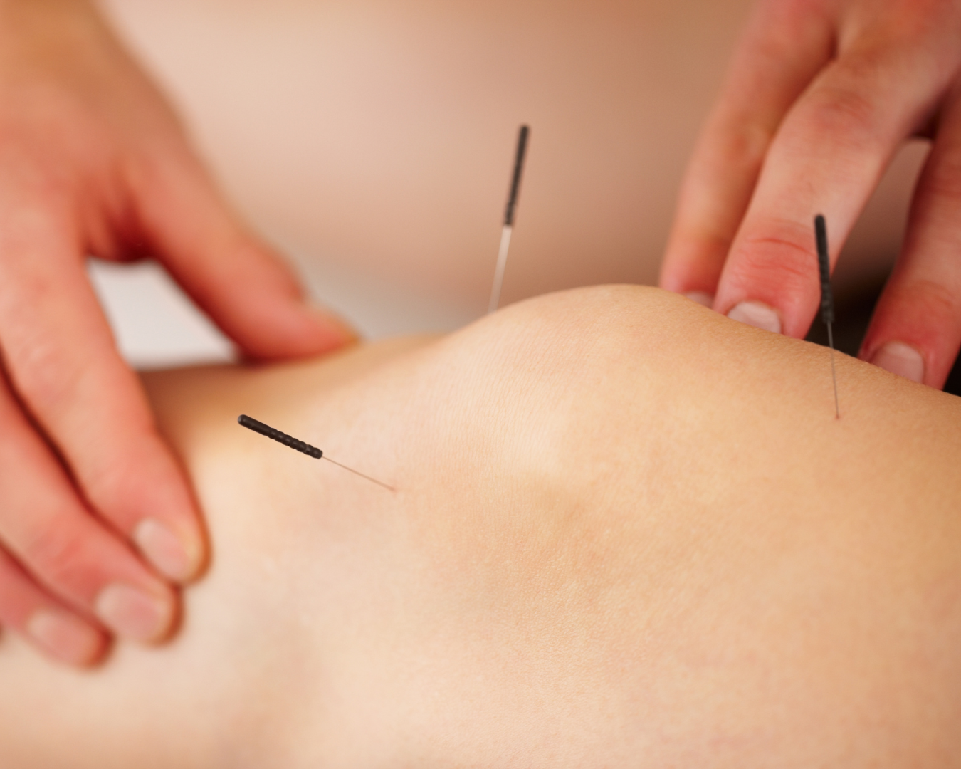 Akkupunktur