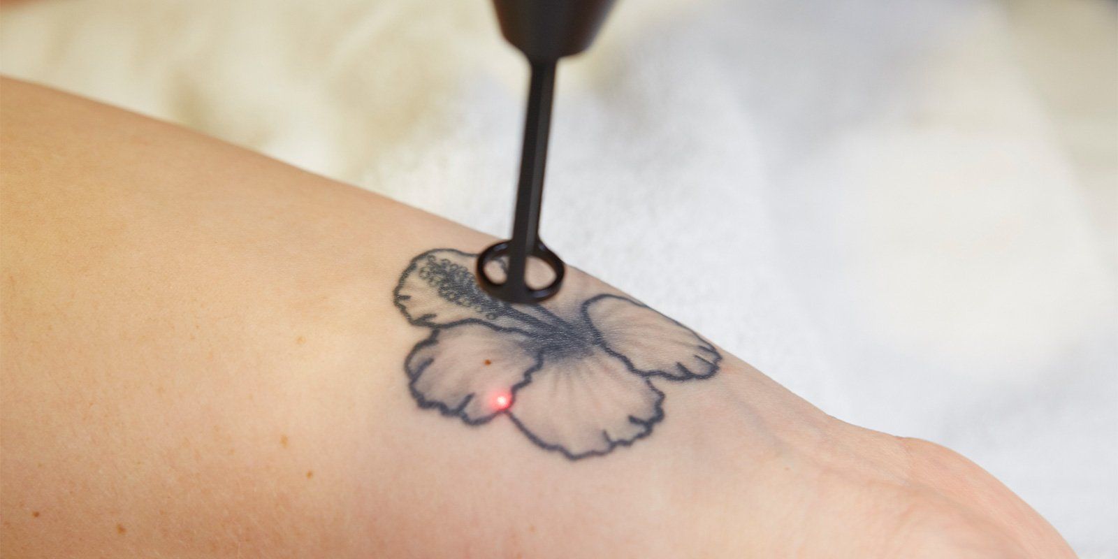 Laser tattoo removal treatment in Norwich