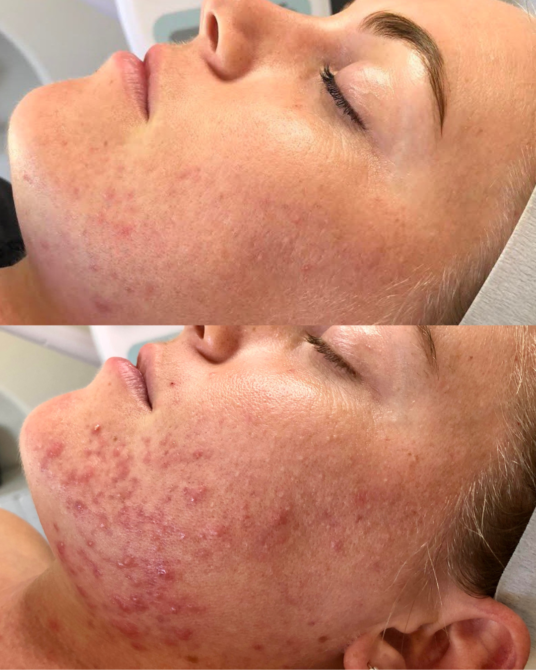 Permanent Makeup, HIFU, Facial, Skin, Acne, Blemish Removal, Laser Hair Removal, Clinic, Norwich