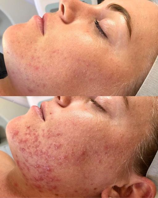 Permanent Makeup, HIFU, Facial, Skin, Acne, Blemish Removal, Laser Hair Removal, Clinic, Norwich