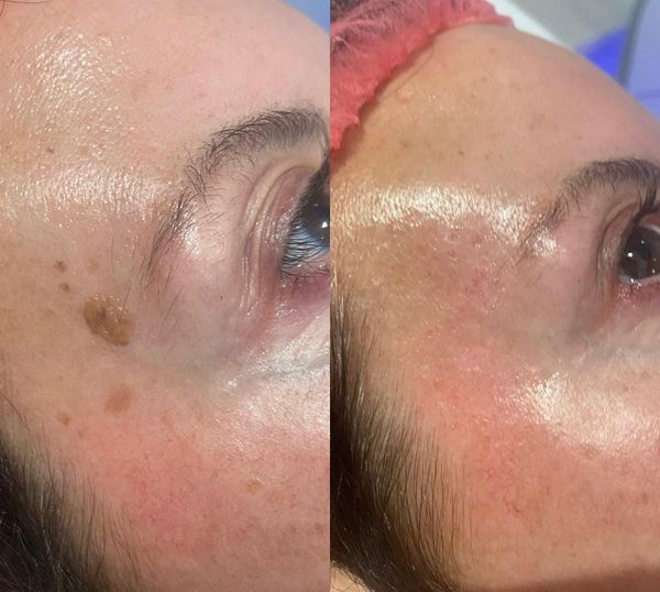 Blemish removal, sebaceous warts,High Grade House Norwich