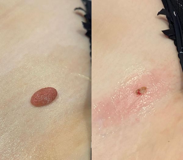 Permanent Makeup, HIFU, Facial, Skin, Acne, Blemish Removal, Laser Hair Removal, Clinic, Norwich