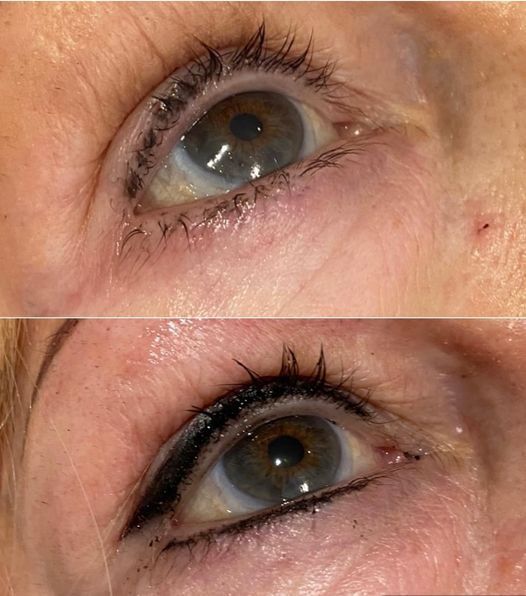 Permanent Makeup, HIFU, Facial, Skin, Acne, Blemish Removal, Laser Hair Removal, Clinic, Norwich