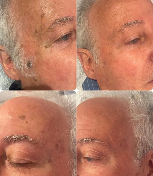 Permanent Makeup, HIFU, Facial, Skin, Acne, Blemish Removal, Laser Hair Removal, Clinic, Norwich