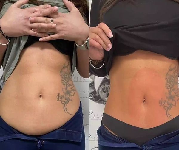 Permanent Makeup, HIFU, Facial, Skin, Acne, Blemish Removal, Laser Hair Removal, Clinic, Norwich