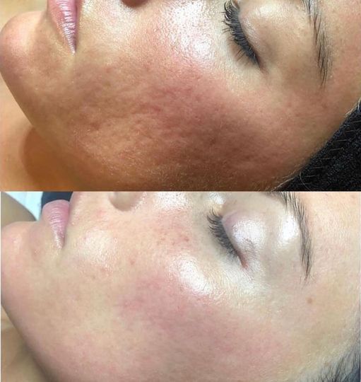 Permanent Makeup, HIFU, Facial, Skin, Acne, Blemish Removal, Laser Hair Removal, Clinic, Norwich