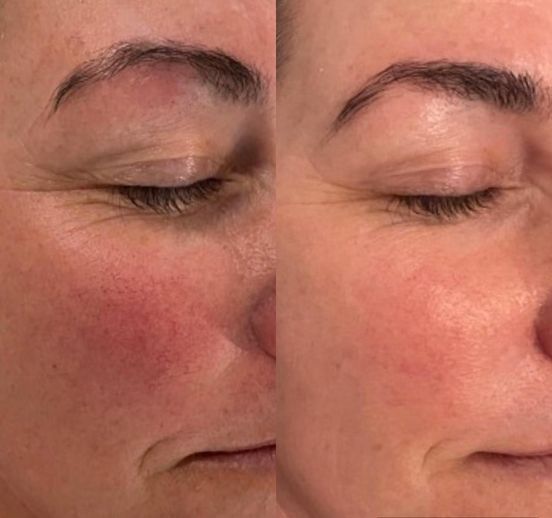 Permanent Makeup, HIFU, Facial, Skin, Acne, Blemish Removal, Laser Hair Removal, Clinic, Norwich