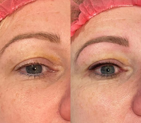 Permanent Makeup, HIFU, Facial, Skin, Acne, Blemish Removal, Laser Hair Removal, Clinic, Norwich