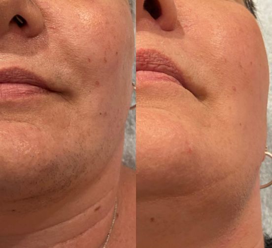 Laser hair removal treatment in Norwich