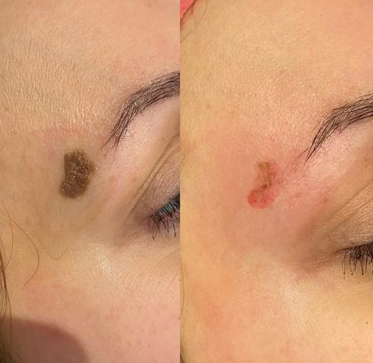 Permanent Makeup, HIFU, Facial, Skin, Acne, Blemish Removal, Laser Hair Removal, Clinic, Norwich