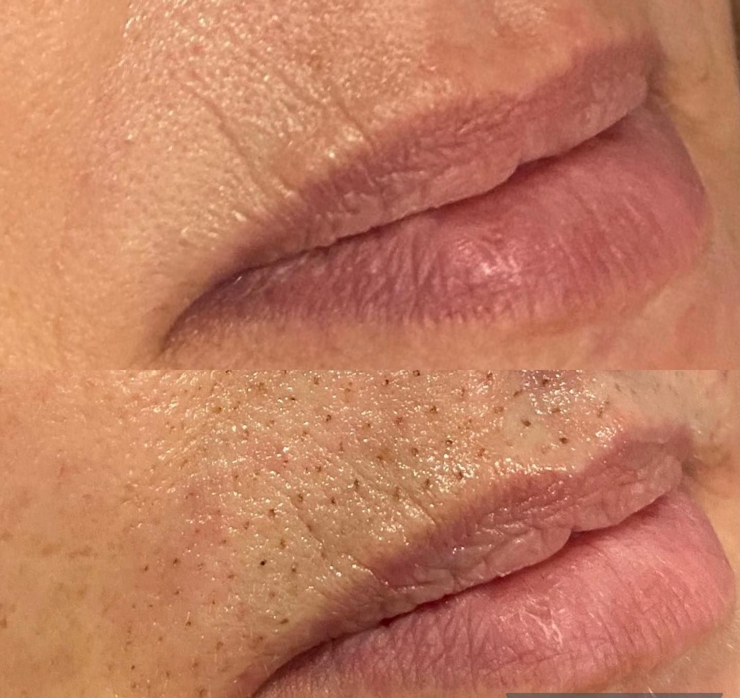 Permanent Makeup, HIFU, Facial, Skin, Acne, Blemish Removal, Laser Hair Removal, Clinic, Norwich