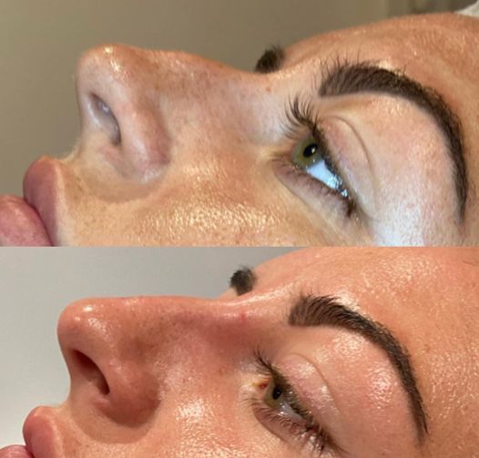 Permanent Makeup, HIFU, Facial, Skin, Acne, Blemish Removal, Laser Hair Removal, Clinic, Norwich