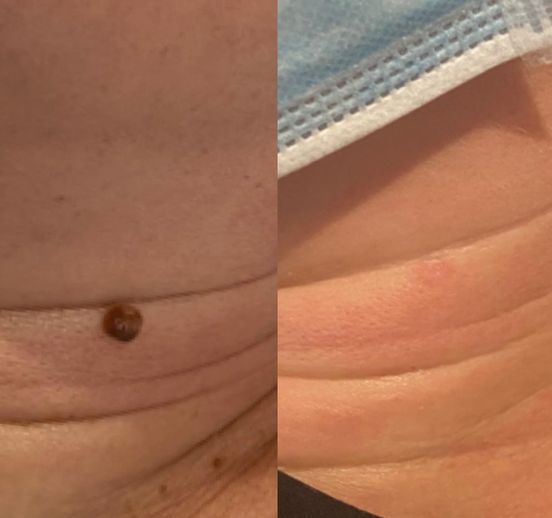 Permanent Makeup, HIFU, Facial, Skin, Acne, Blemish Removal, Laser Hair Removal, Clinic, Norwich