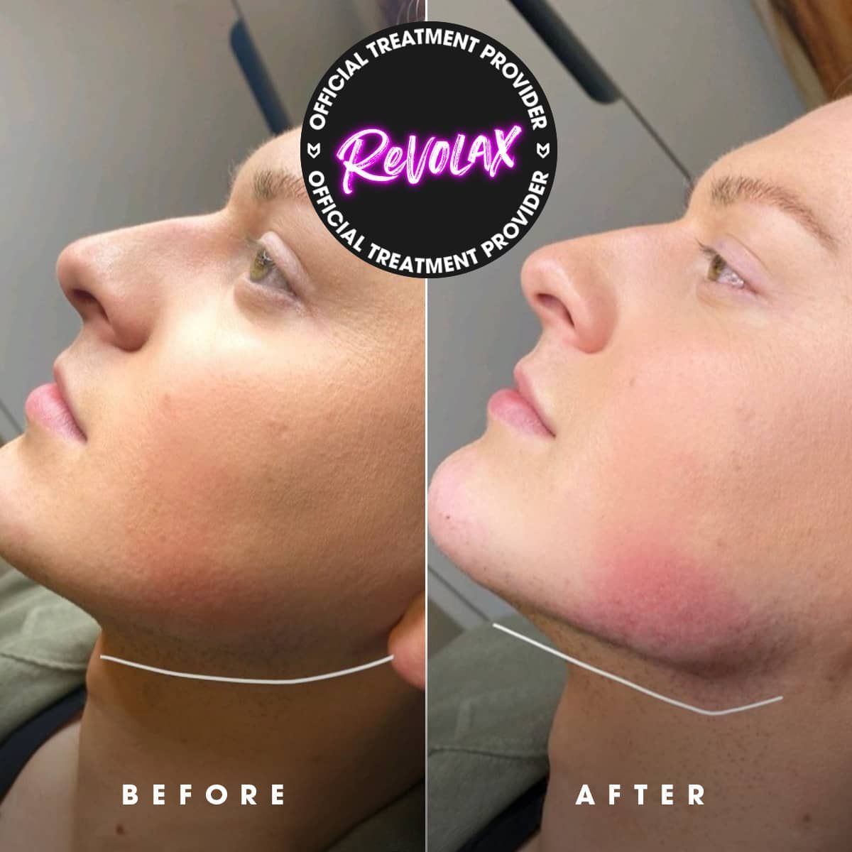 Permanent Makeup, HIFU, Facial, Skin, Acne, Blemish Removal, Laser Hair Removal, Clinic, Norwich