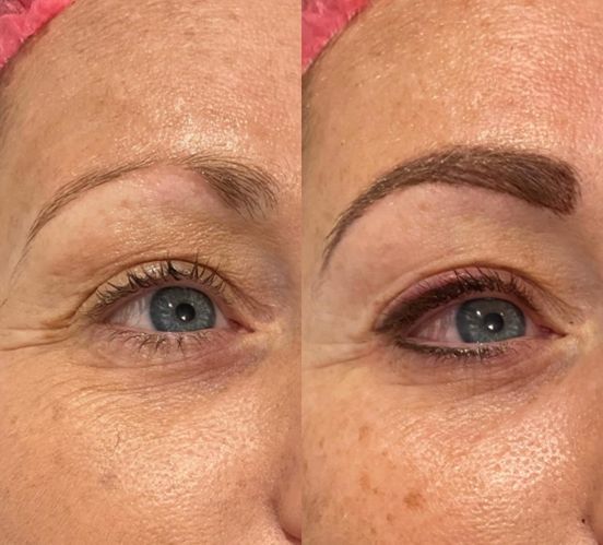 Permanent Makeup, HIFU, Facial, Skin, Acne, Blemish Removal, Laser Hair Removal, Clinic, Norwich
