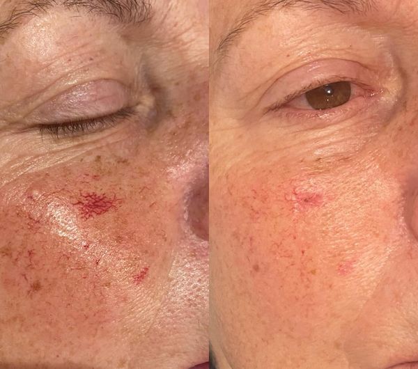 Blemish removal, vein removal,High Grade House Norwich