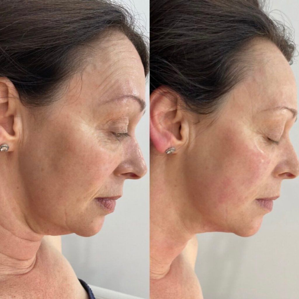 HIFU non-surgical facelift treatment in Norwich