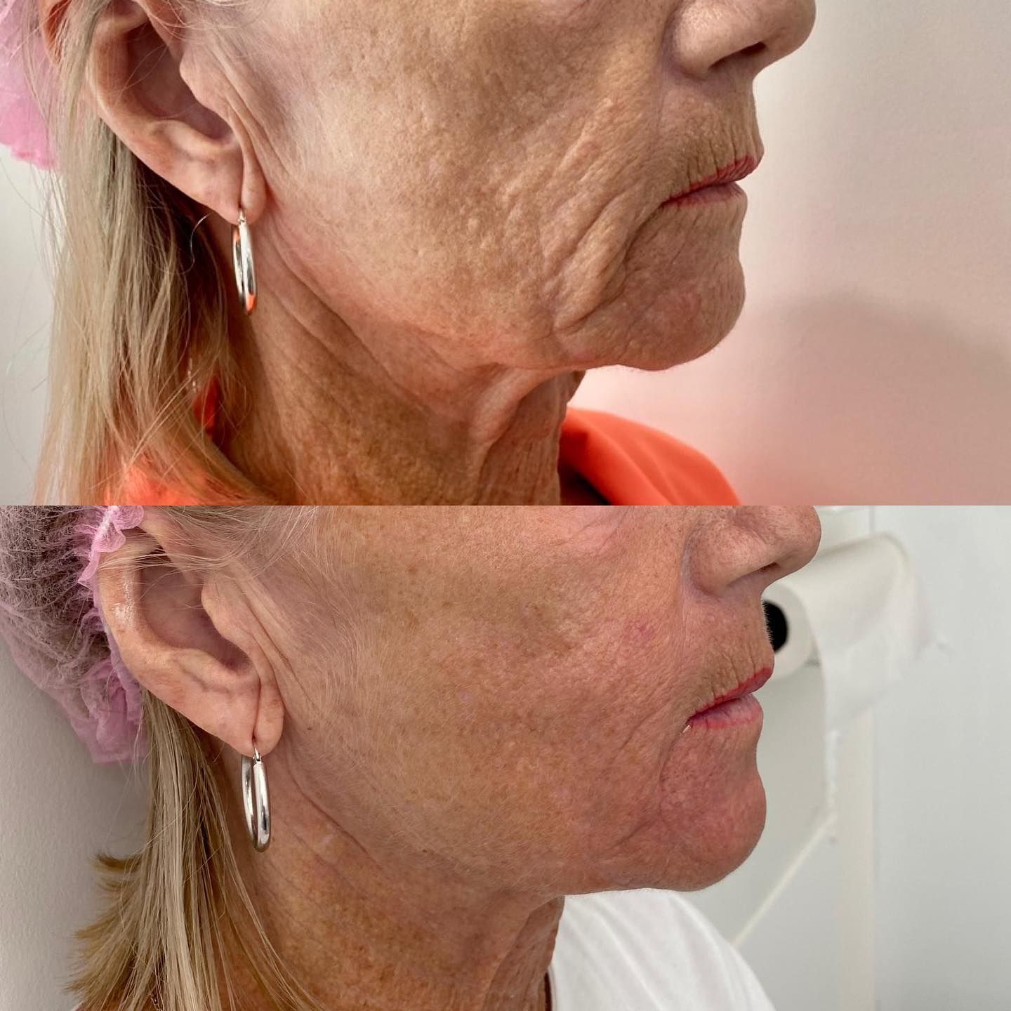 Permanent Makeup, HIFU, Facial, Skin, Acne, Blemish Removal, Laser Hair Removal, Clinic, Norwich