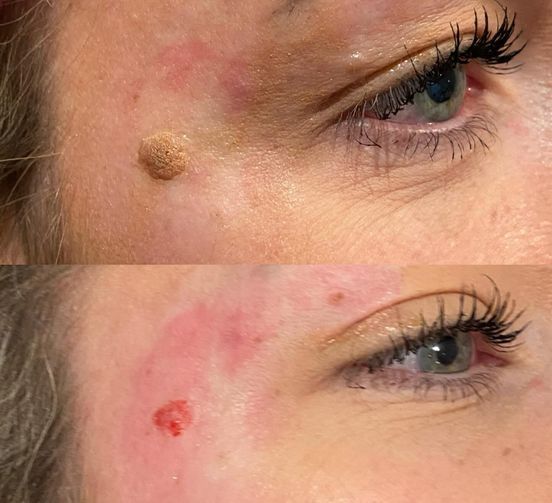 Permanent Makeup, HIFU, Facial, Skin, Acne, Blemish Removal, Laser Hair Removal, Clinic, Norwich