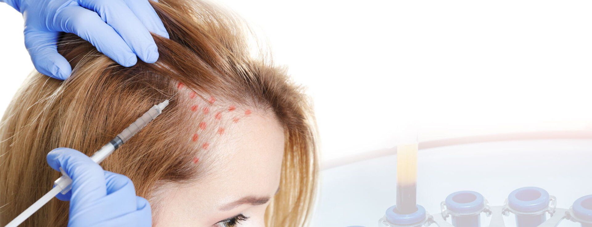 PRP plasma rich skin treatment in Norwich