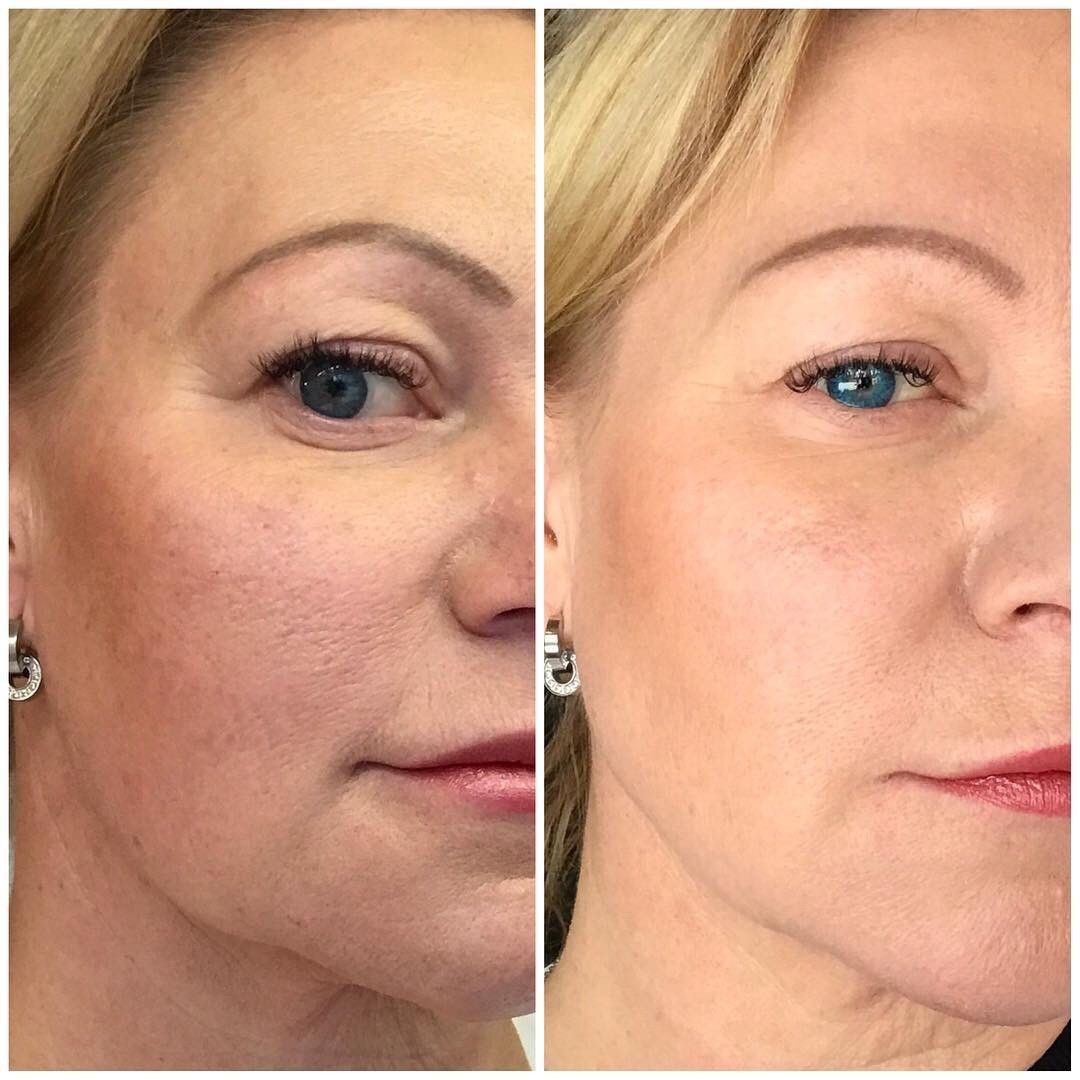 Permanent Makeup, HIFU, Facial, Skin, Acne, Blemish Removal, Laser Hair Removal, Clinic, Norwich