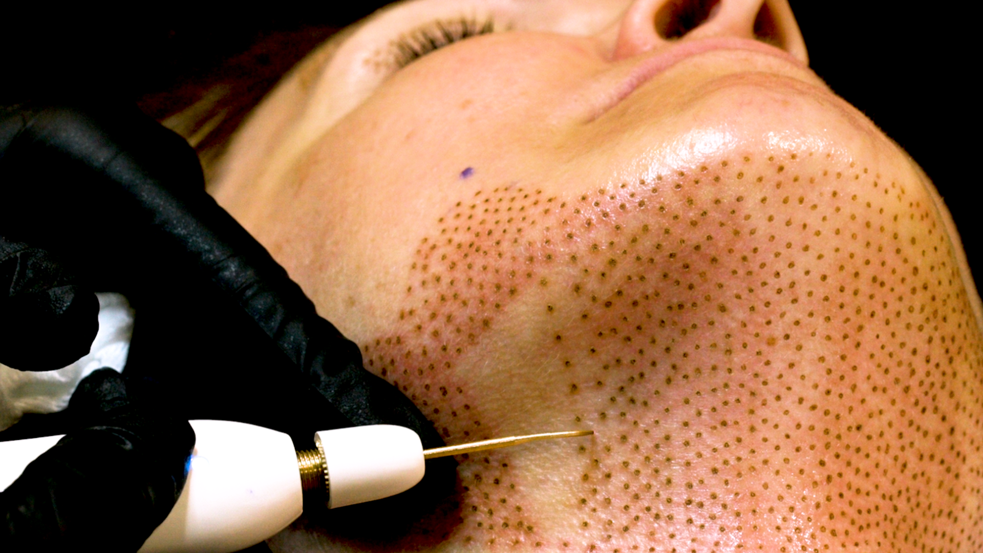 Permanent Makeup, HIFU, Facial, Skin, Acne, Blemish Removal, Laser Hair Removal, Clinic, Norwich