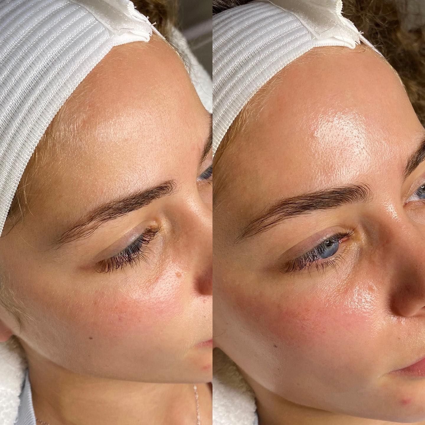 Permanent Makeup, HIFU, Facial, Skin, Acne, Blemish Removal, Laser Hair Removal, Clinic, Norwich