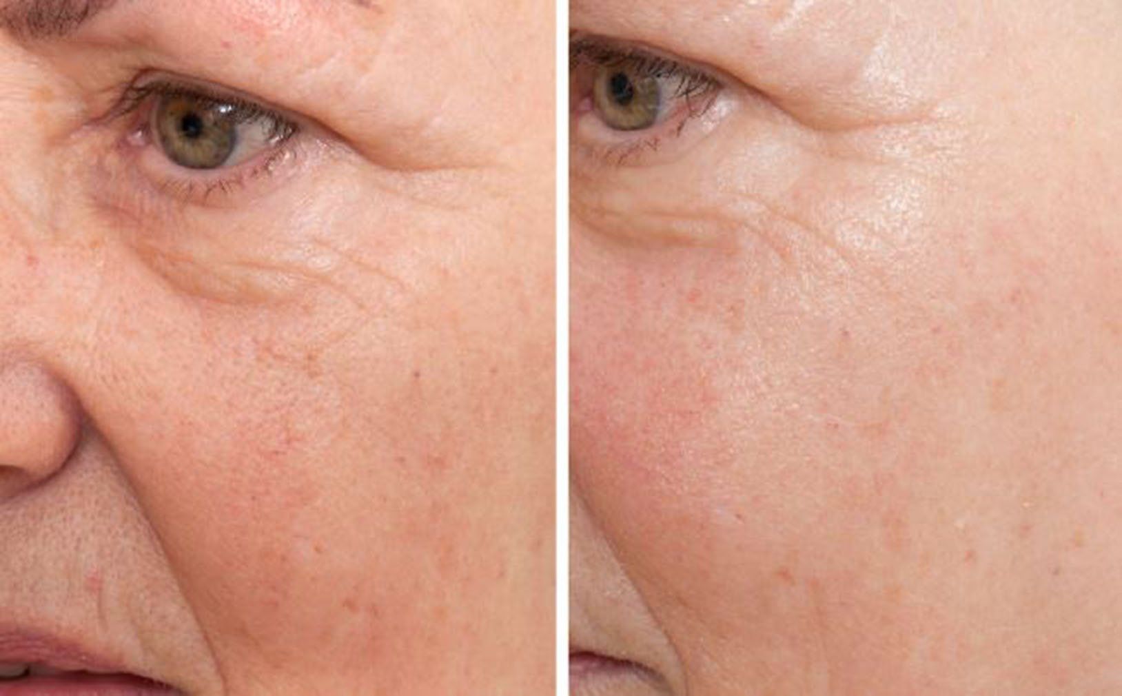 RF Radio Frequency treatment in Norwich