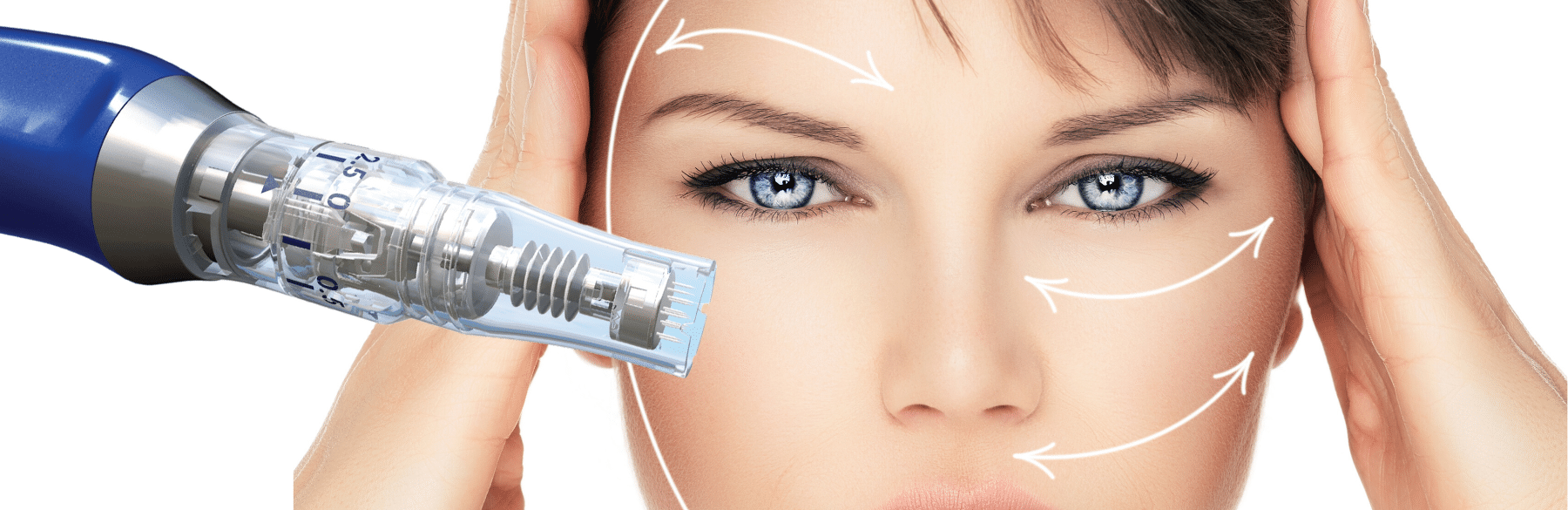 Microneedling treatment in Norwich