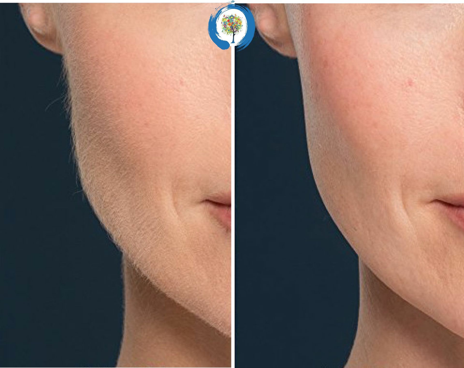 Permanent Makeup, HIFU, Facial, Skin, Acne, Blemish Removal, Laser Hair Removal, Clinic, Norwich