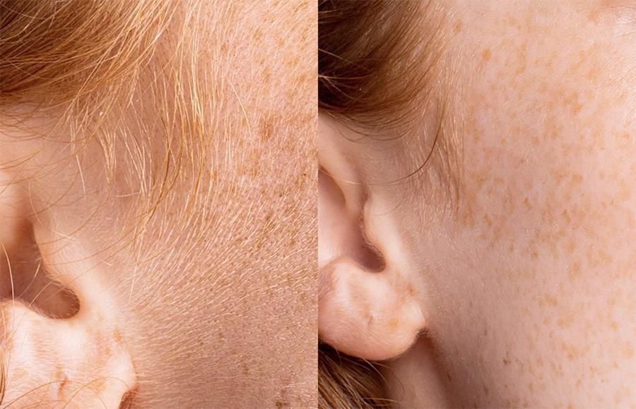 Permanent Makeup, HIFU, Facial, Skin, Acne, Blemish Removal, Laser Hair Removal, Clinic, Norwich