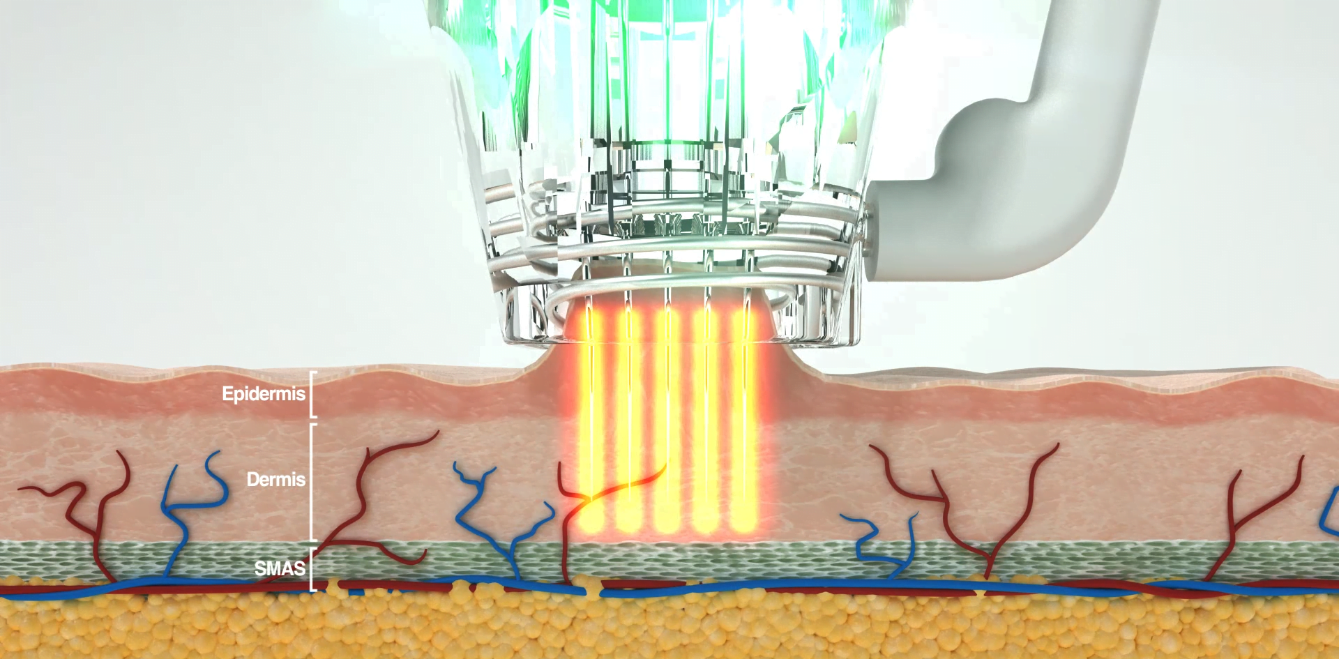 Fractional Microneedling treatment in Norwich