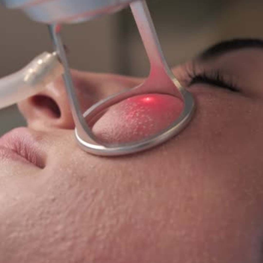 CO2 Fractional laser , High Grade House, Norwich