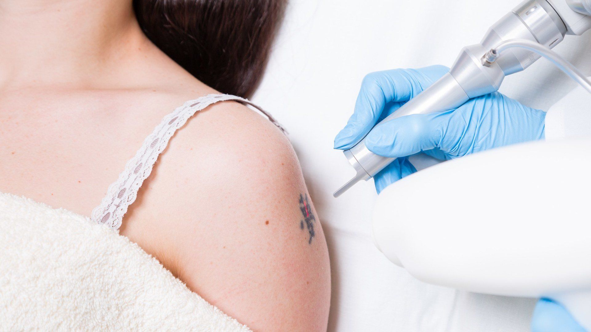 Laser tattoo removal treatment in Norwich