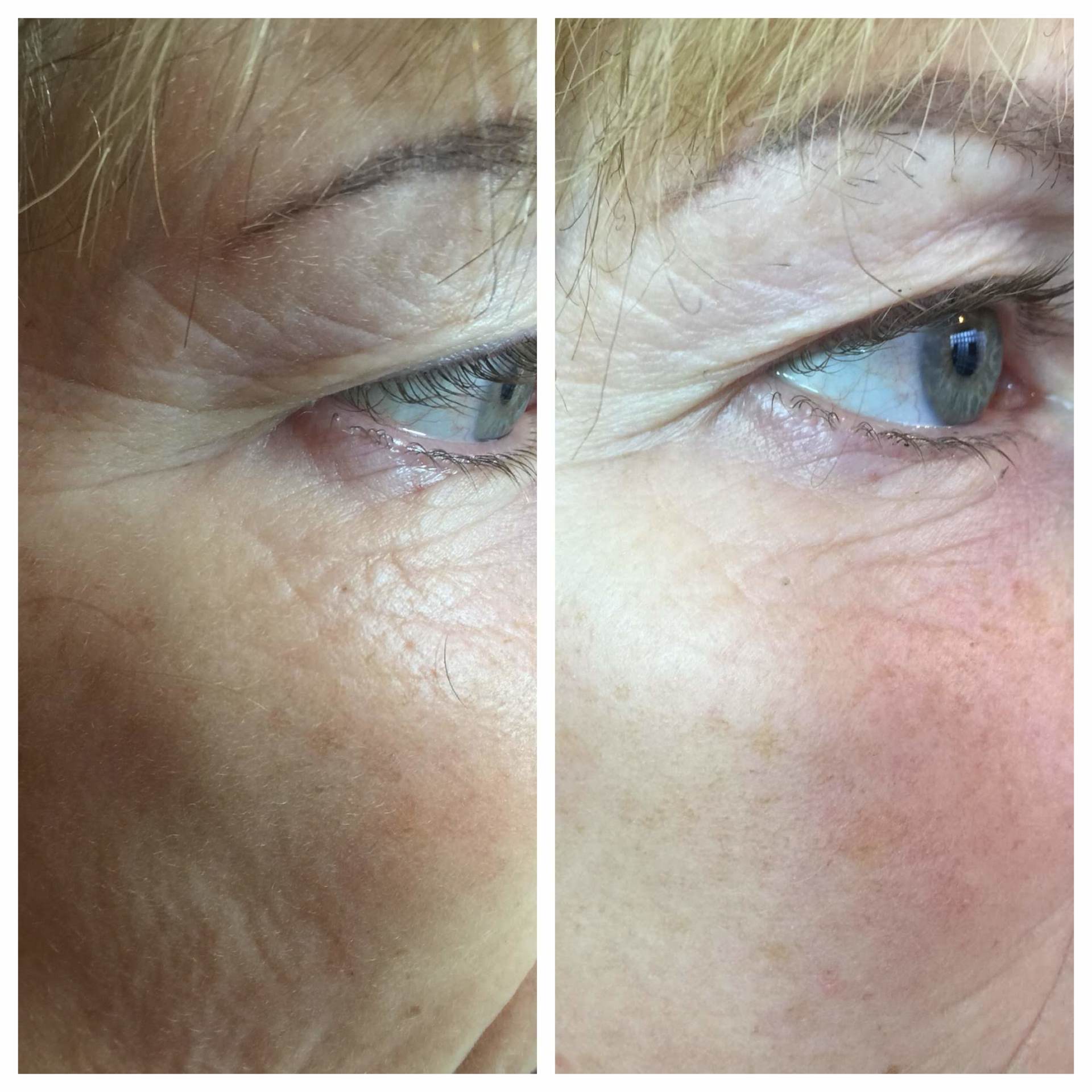 Permanent Makeup, HIFU, Facial, Skin, Acne, Blemish Removal, Laser Hair Removal, Clinic, Norwich