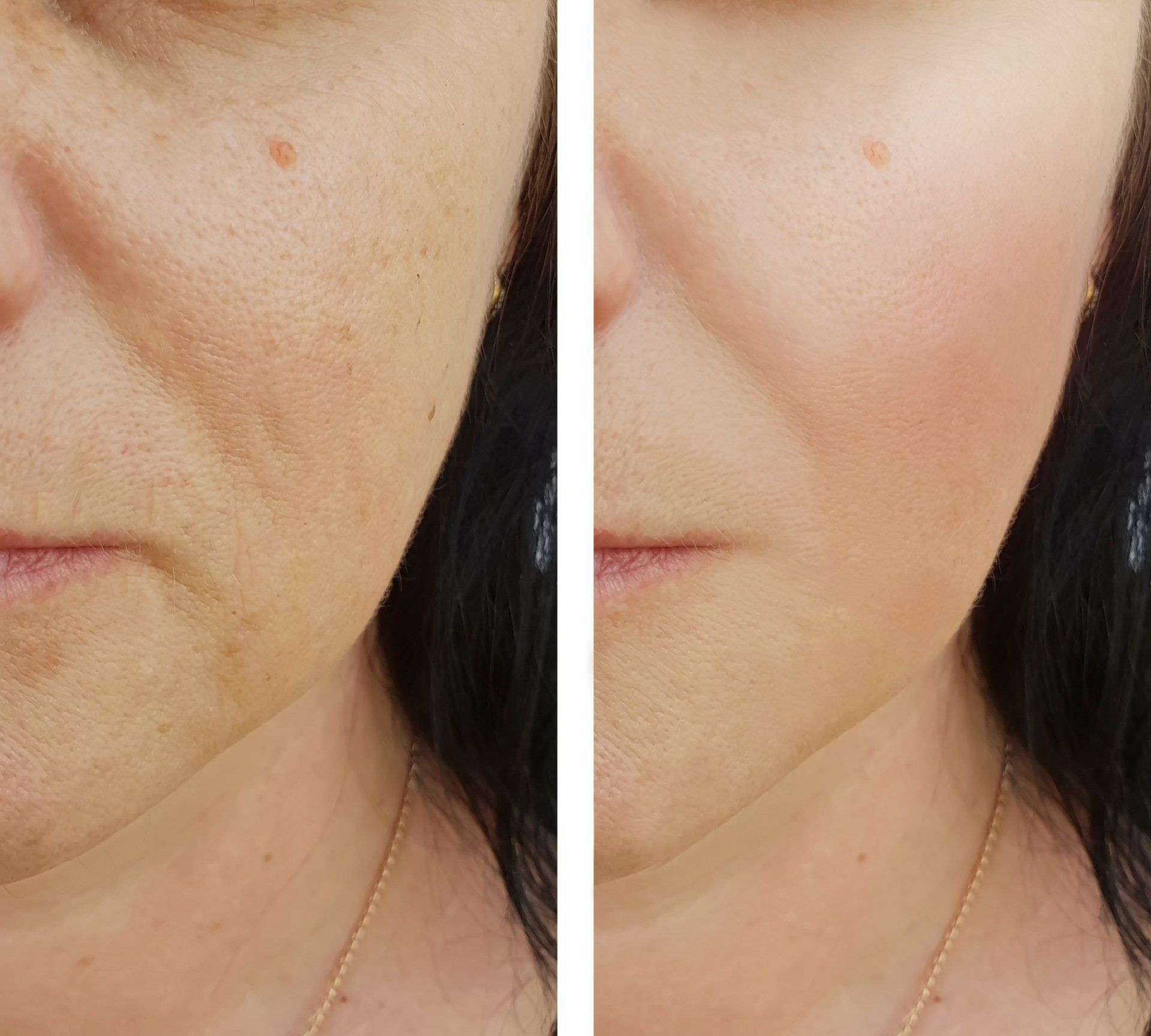 Microneedling treatment in Norwich