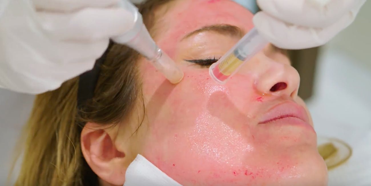 PRP plasma rich skin treatment in Norwich