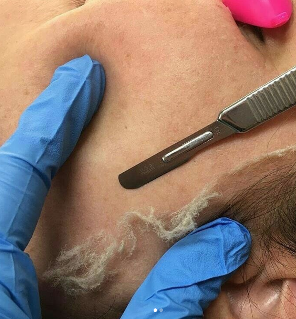 Permanent Makeup, HIFU, Facial, Skin, Acne, Blemish Removal, Laser Hair Removal, Clinic, Norwich