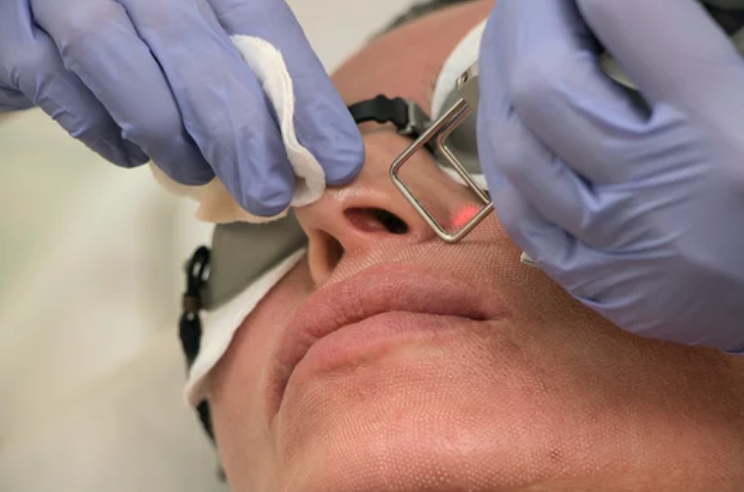 CO2 Fractional laser , High Grade House, Norwich