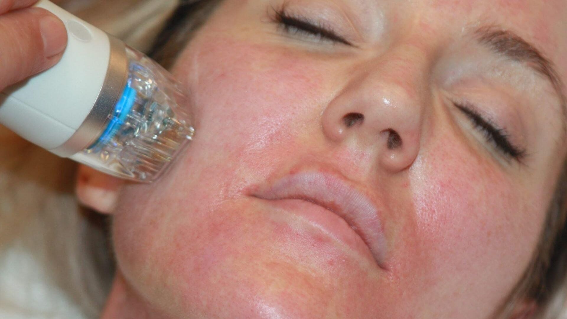 Fractional Microneedling treatment in Norwich