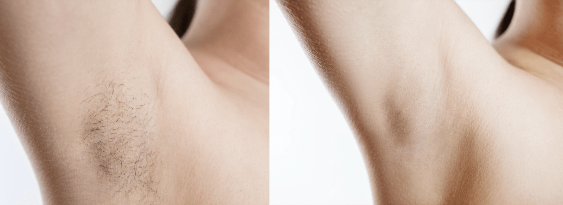 Laser hair removal treatment in Norwich