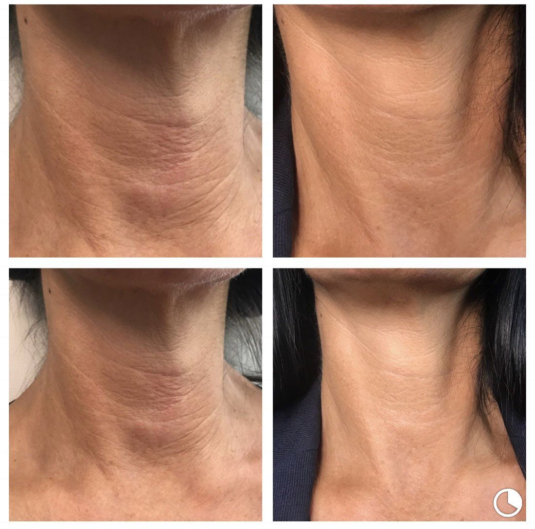 HIFU non-surgical facelift treatment in Norwich