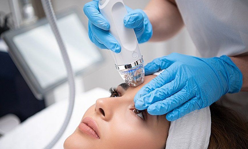 Fractional Microneedling treatment in Norwich