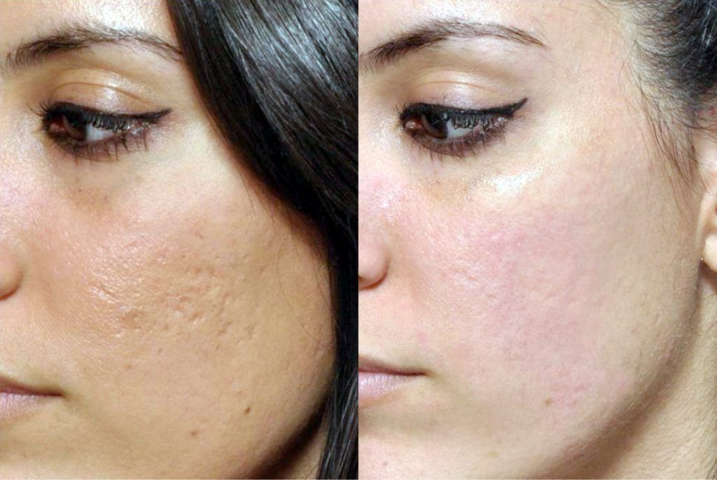 Microneedling treatment in Norwich