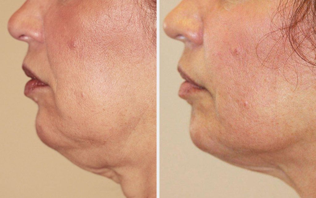 Permanent Makeup, HIFU, Facial, Skin, Acne, Blemish Removal, Laser Hair Removal, Clinic, Norwich
