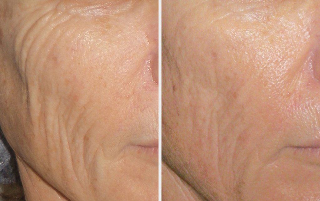 Permanent Makeup, HIFU, Facial, Skin, Acne, Blemish Removal, Laser Hair Removal, Clinic, Norwich