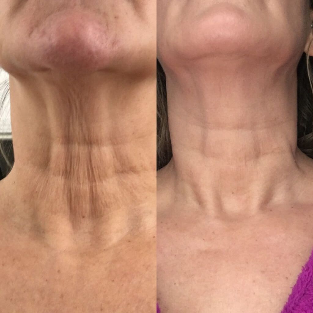 Permanent Makeup, HIFU, Facial, Skin, Acne, Blemish Removal, Laser Hair Removal, Clinic, Norwich