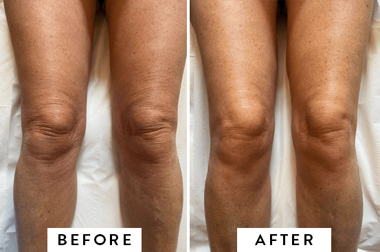 Fractional Microneedling treatment in Norwich